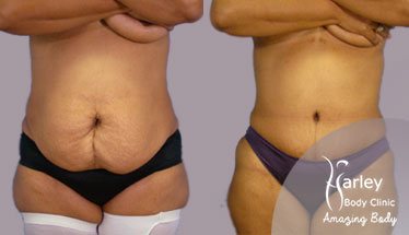 Stomach Liposuction London, Tummy Lipo UK