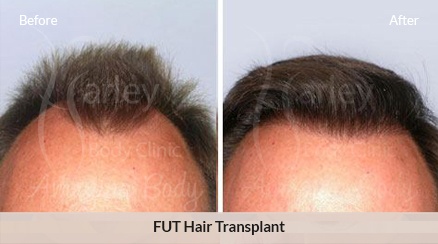 FUE Hair Transplant Before After Photo | FUT Hair Restoration Before After  Image