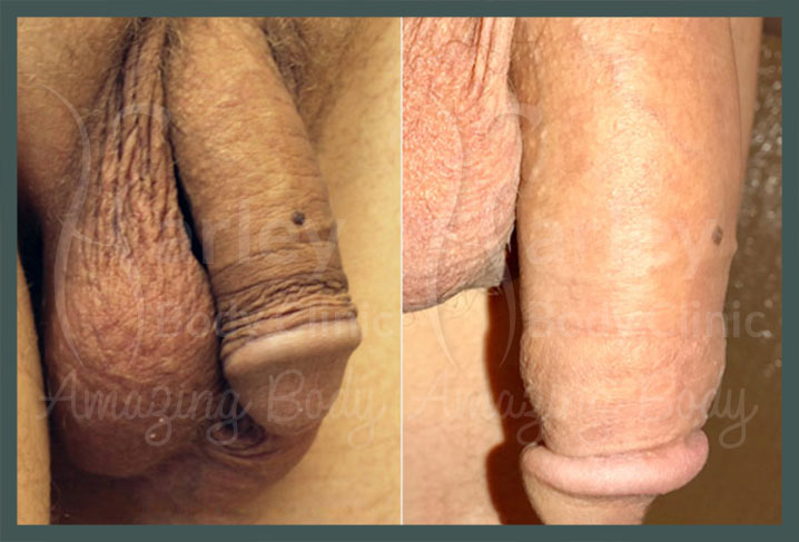 What are the surgical methods used for penis enlargement? 