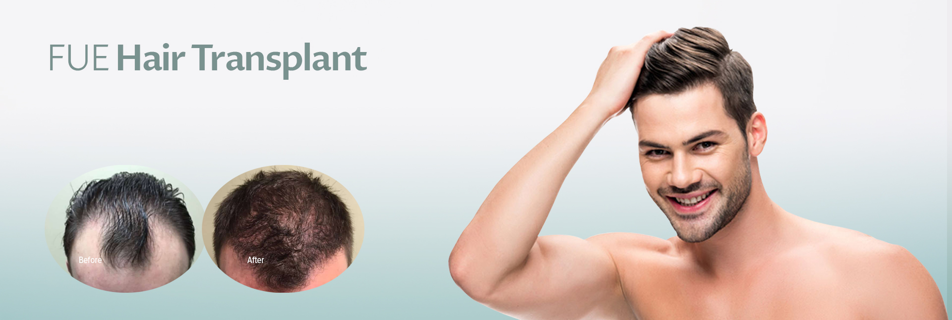FUE Hair Transplant Surgery Cost | Hair Restoration Clinic London